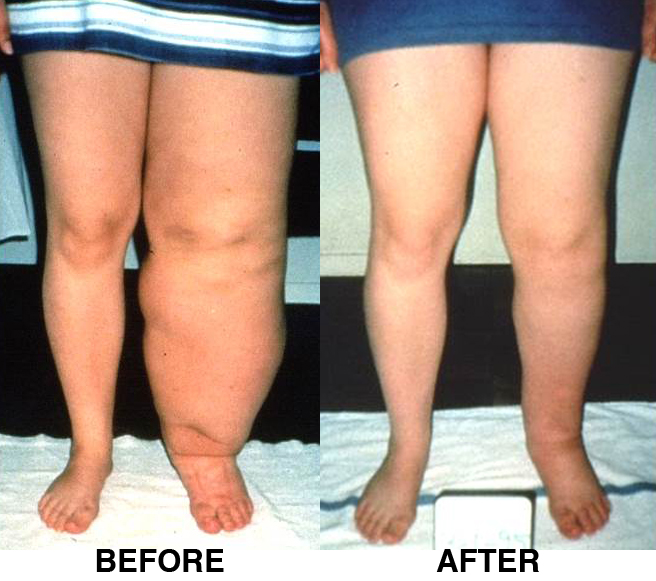 Lymphedema Treatment