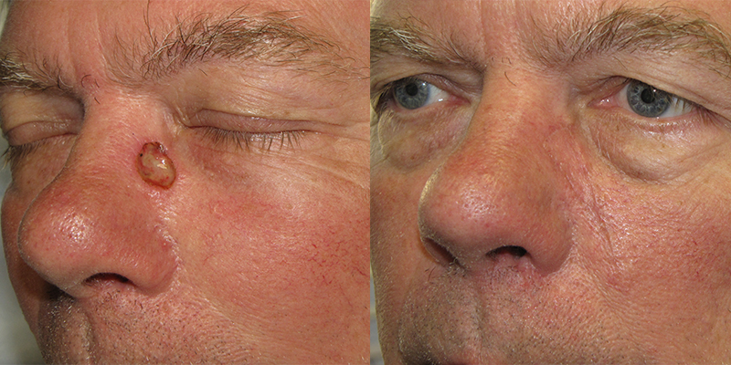 Cancer Reconstruction