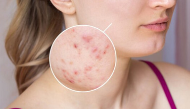 Acne And Skin Issues