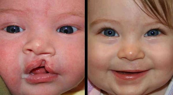 Cleft Lip Repair