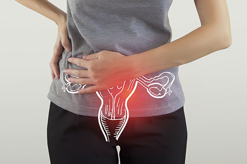 Ovarian Cysts