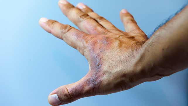 Burn Treatment