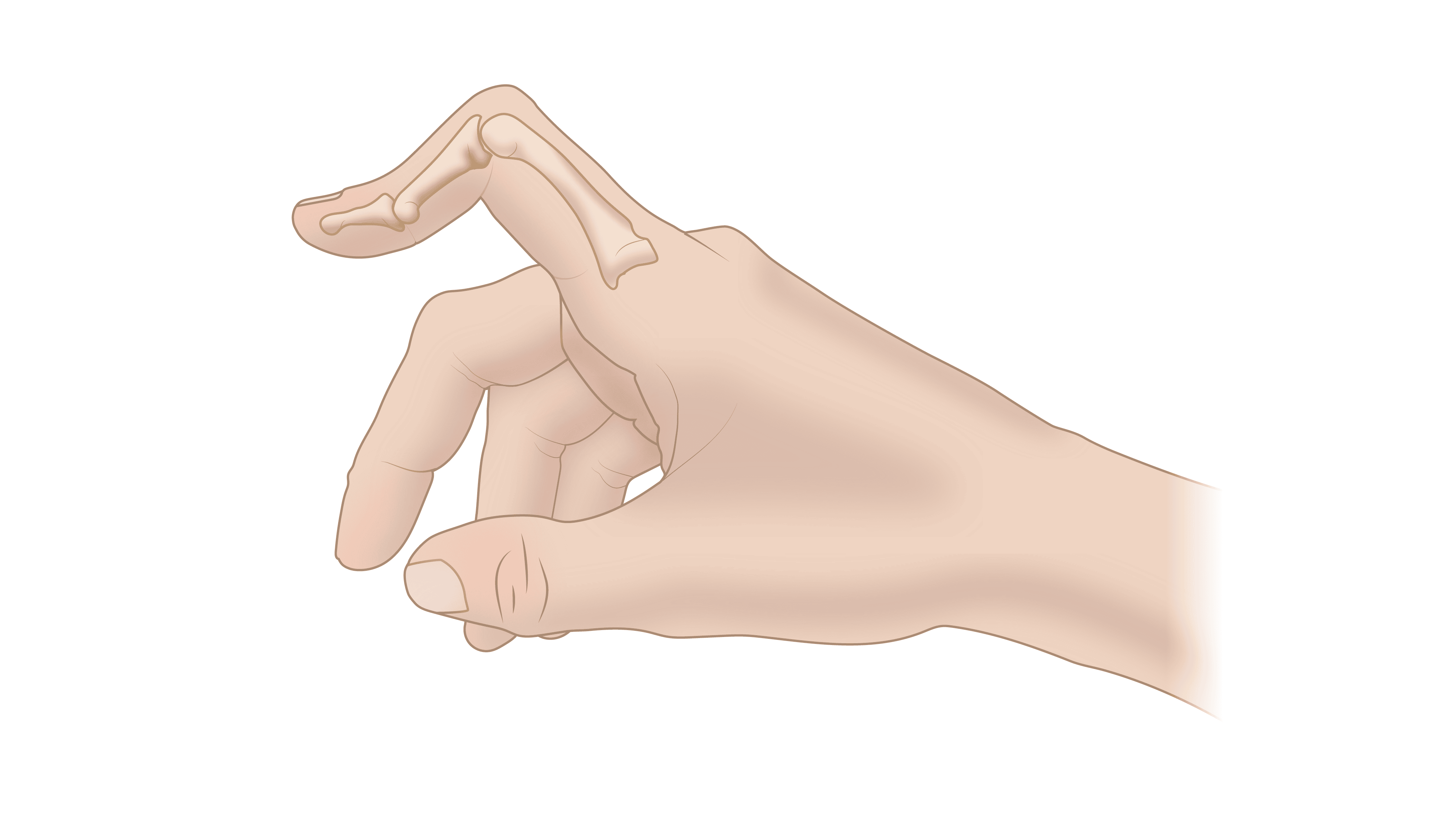 Hand Deformity Repair