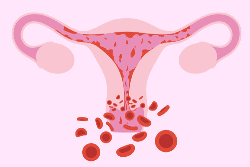 Menstrual And Bleeding Problems
