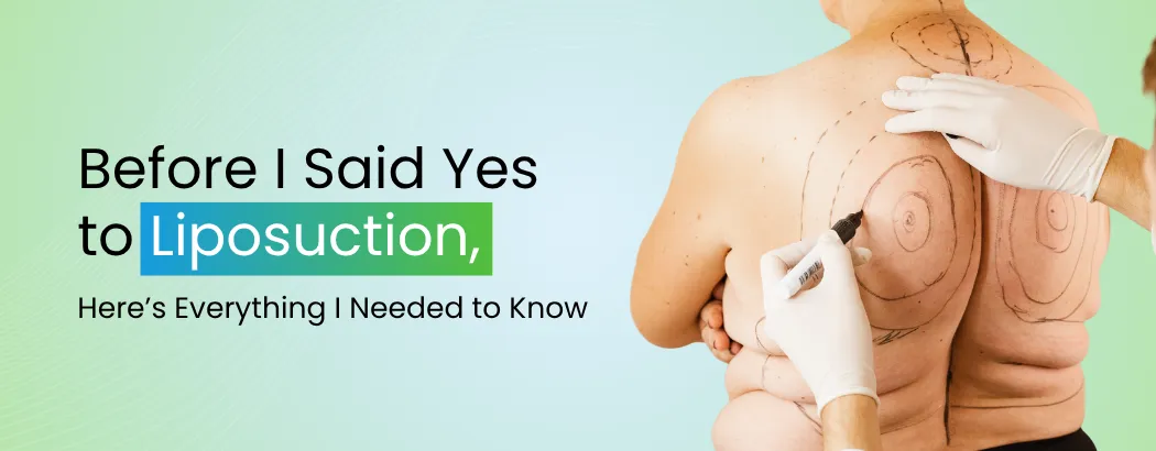 Before I Said Yes to Liposuction, Here’s Everything I Needed to Know