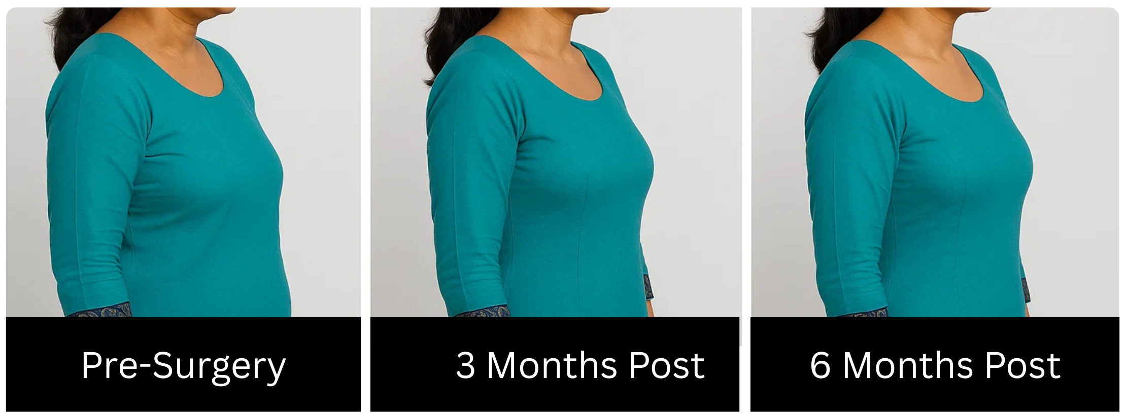 Before and after body treatment photos showing patient progression at pre-surgery, 3 months, and 6 months post-treatment