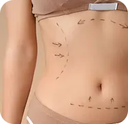 An icon of a body diagram with markings, indicating a customized liposuction plan.