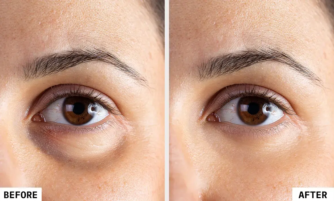 Under-Eye Fillers