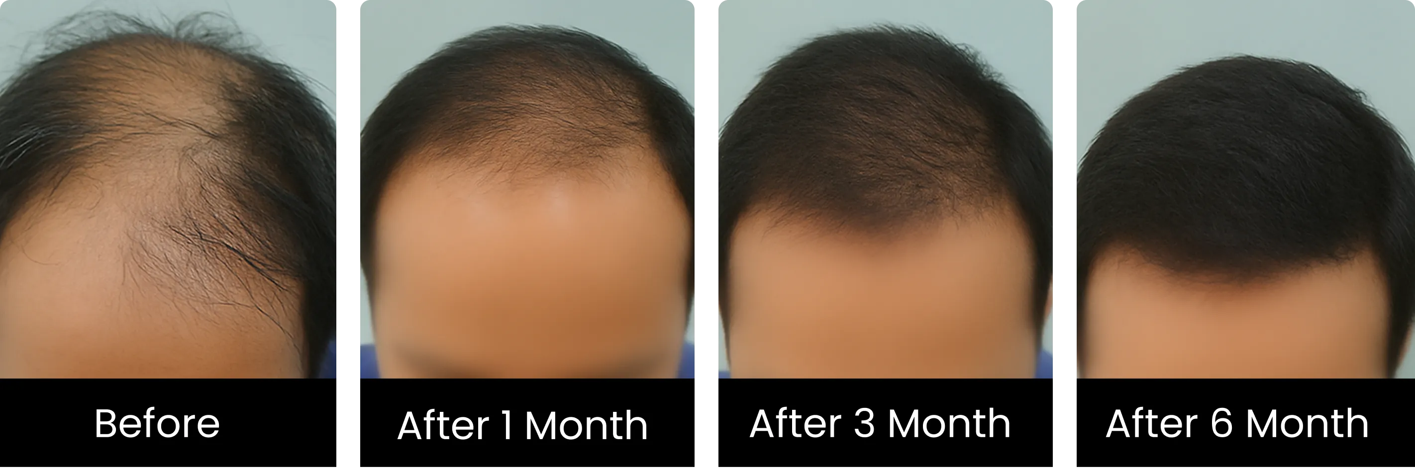  Hair Transplant Before and After – Minnerva Clinic Lucknow