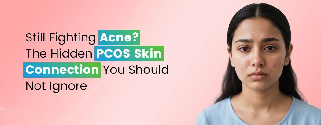 Still Fighting Acne? The Hidden PCOS Skin Connection You Should Not Ignore